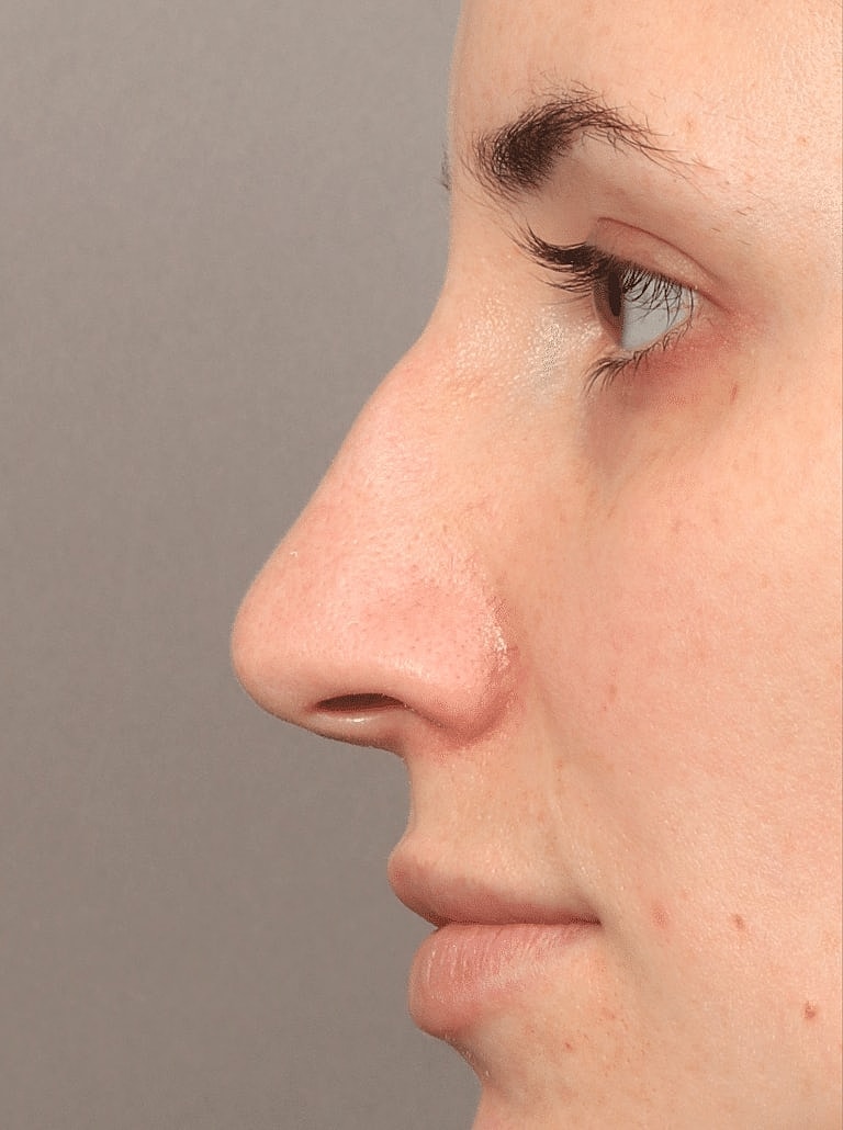 Nose Job Rhinoplasty Before & After