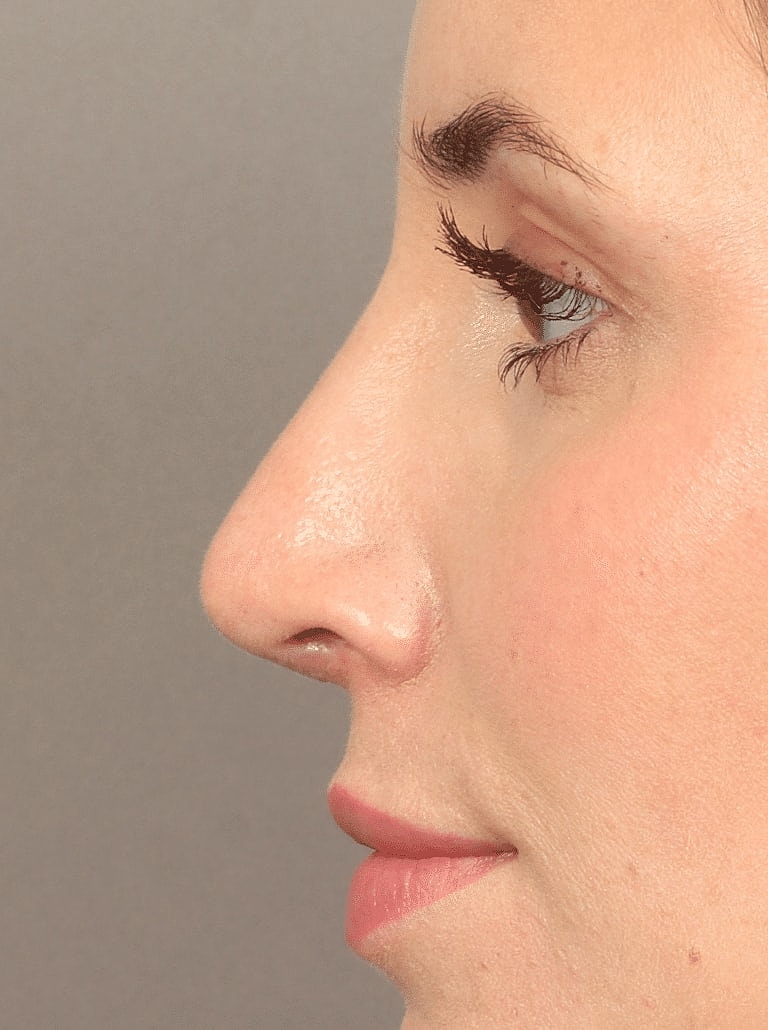 Nose Job Rhinoplasty Before & After