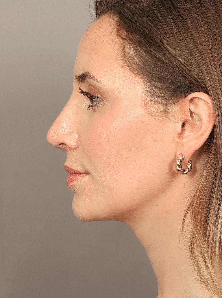 Nose Job Rhinoplasty Before & After