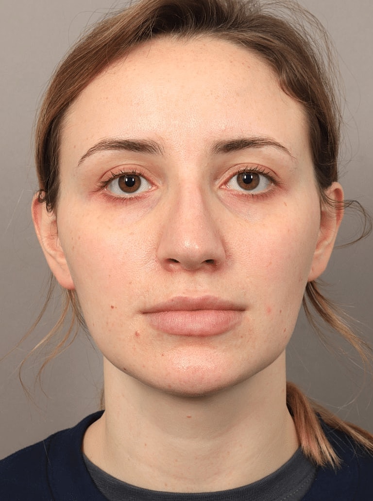 Nose Job Rhinoplasty Before & After