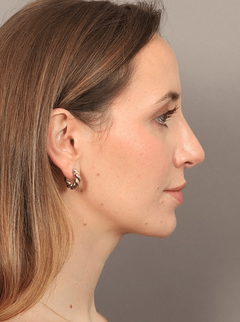 Nose Job Rhinoplasty Before & After