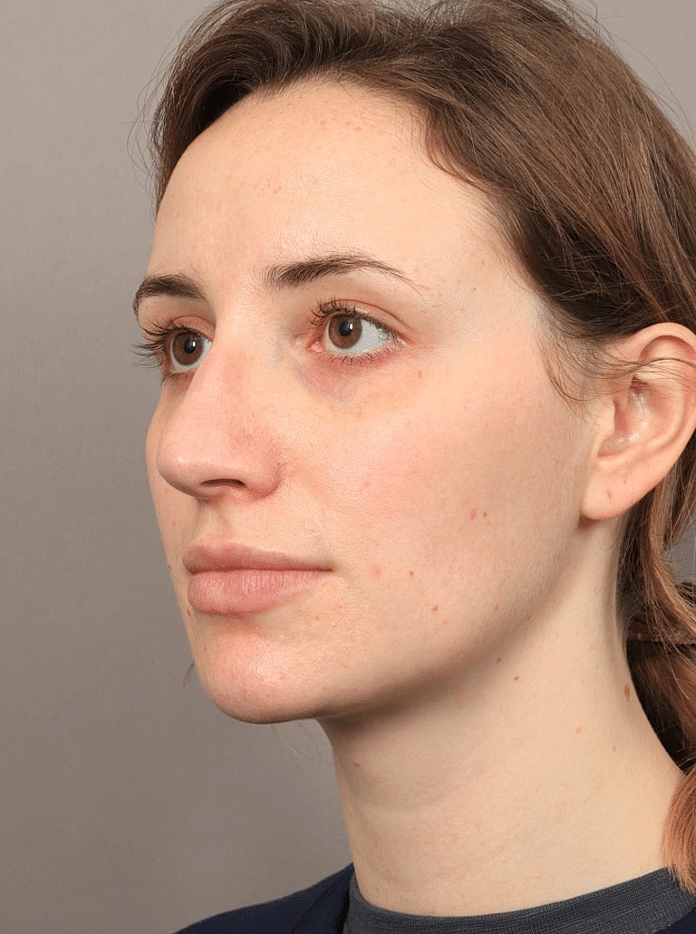 Nose Job Rhinoplasty Before & After