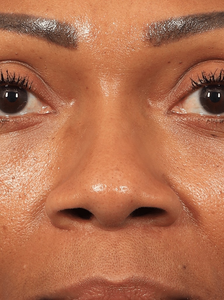 Nose Job Rhinoplasty Before & After