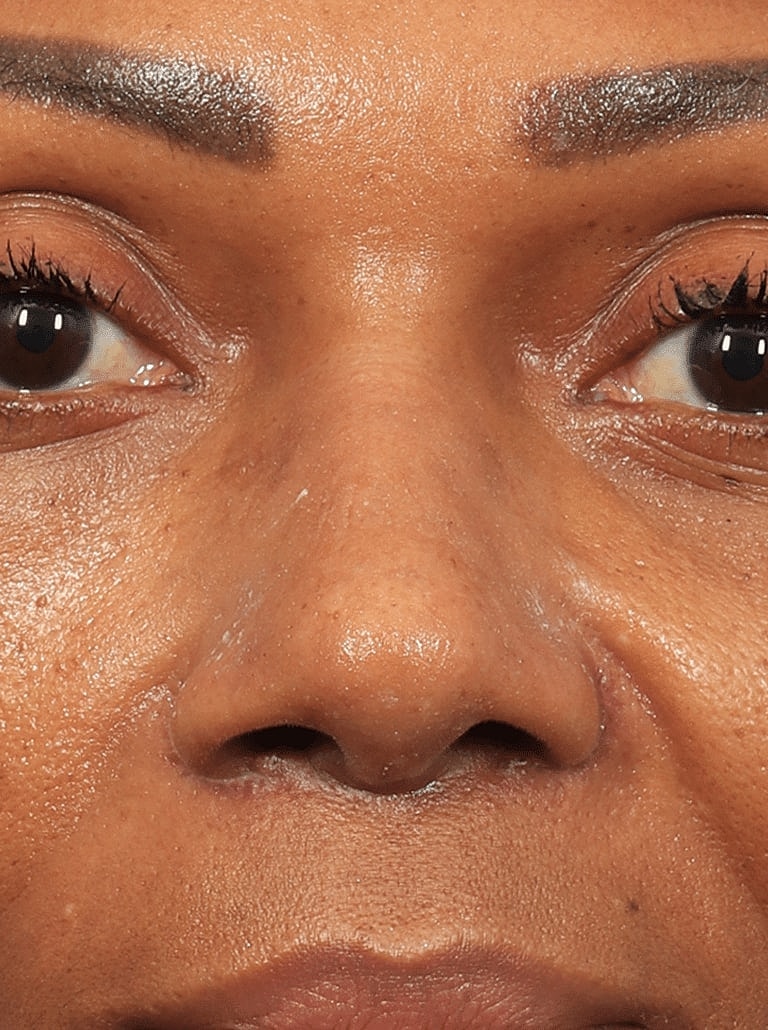 Nose Job Rhinoplasty Before & After