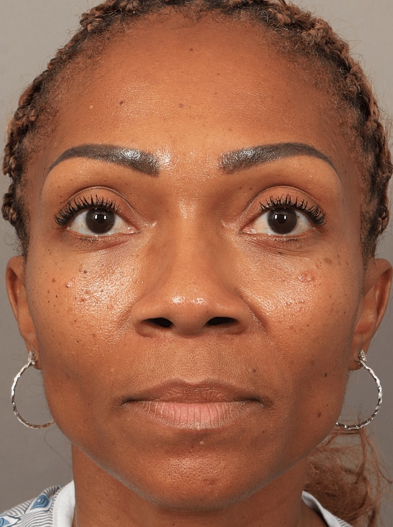 Nose Job Rhinoplasty Before & After