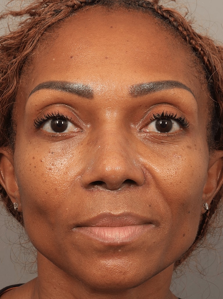 Nose Job Rhinoplasty Before & After