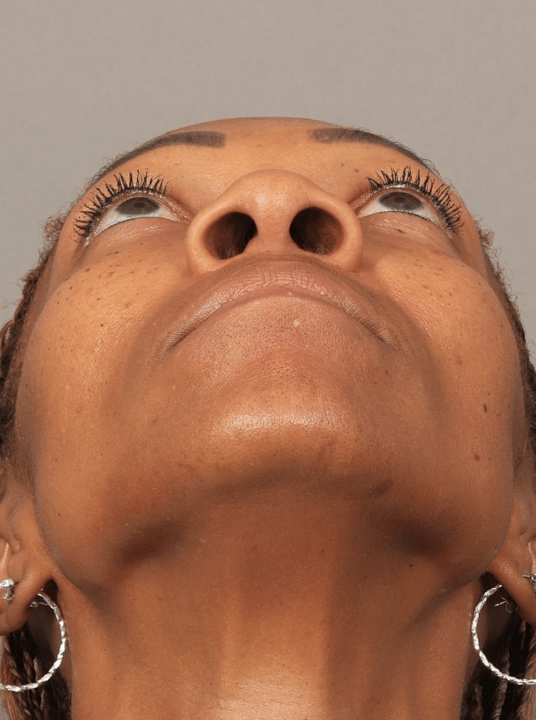 Nose Job Rhinoplasty Before & After