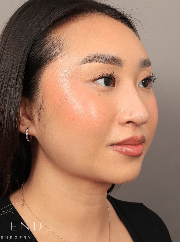 Nose Job Rhinoplasty Before & After