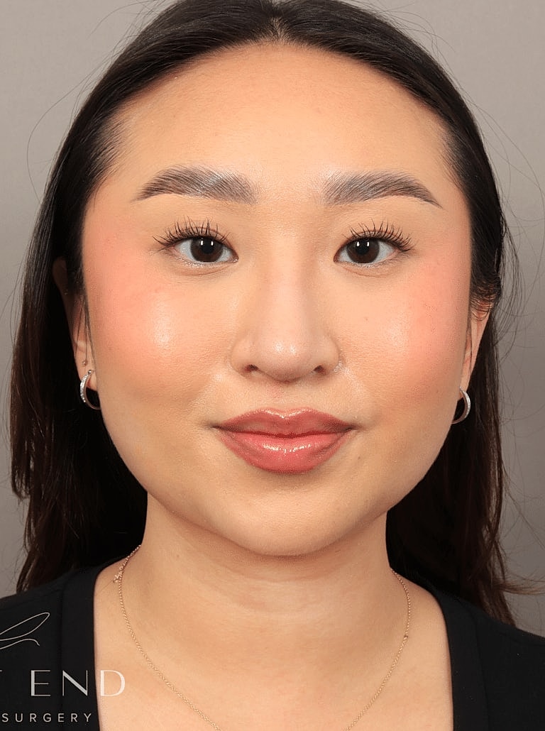 Nose Job Rhinoplasty Before & After