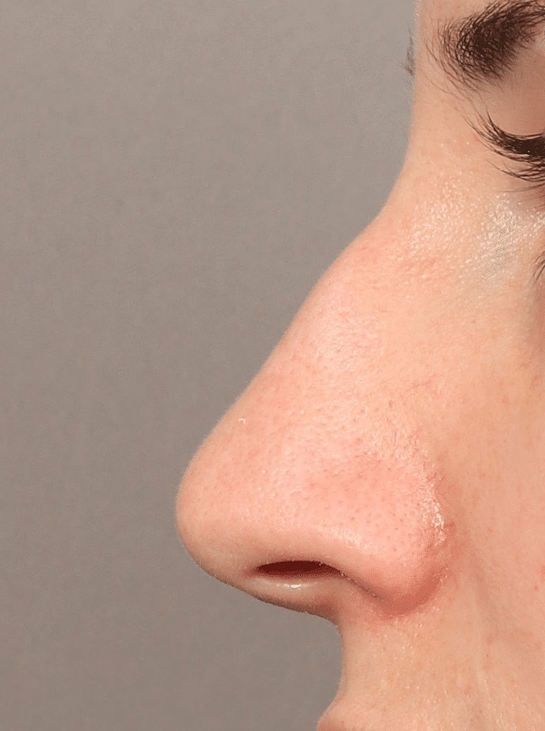 Nose Job Rhinoplasty Before & After