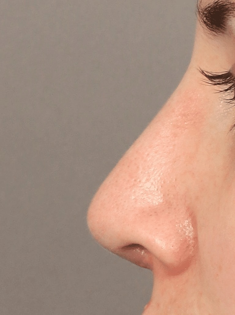 Nose Job Rhinoplasty Before & After