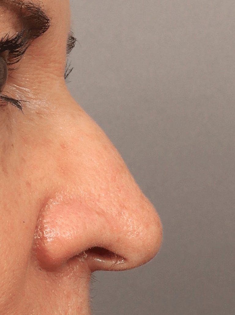 Nose Job Rhinoplasty Before & After