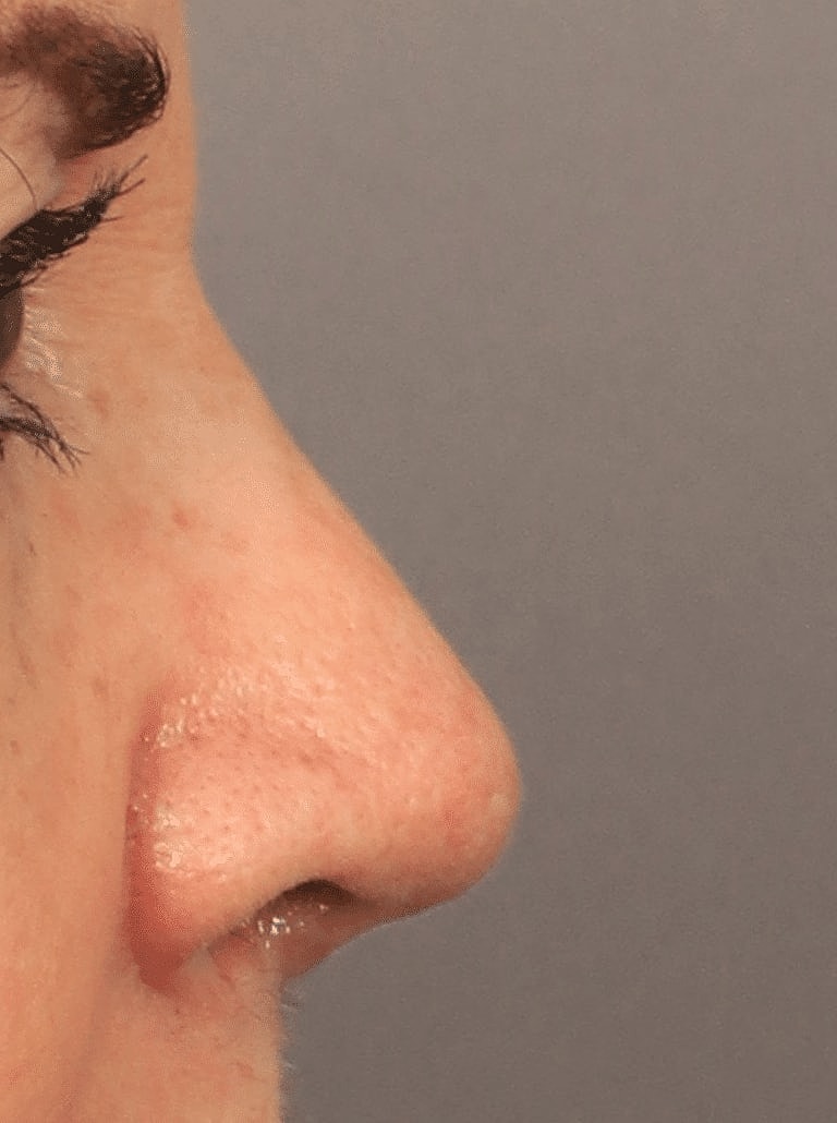 Nose Job Rhinoplasty Before & After