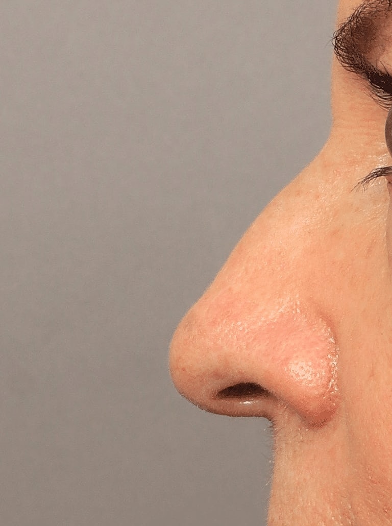 Nose Job Rhinoplasty Before & After