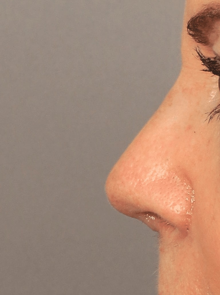 Nose Job Rhinoplasty Before & After