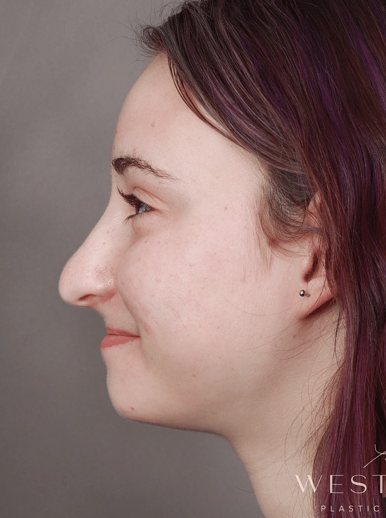 Nose Job Rhinoplasty Before & After