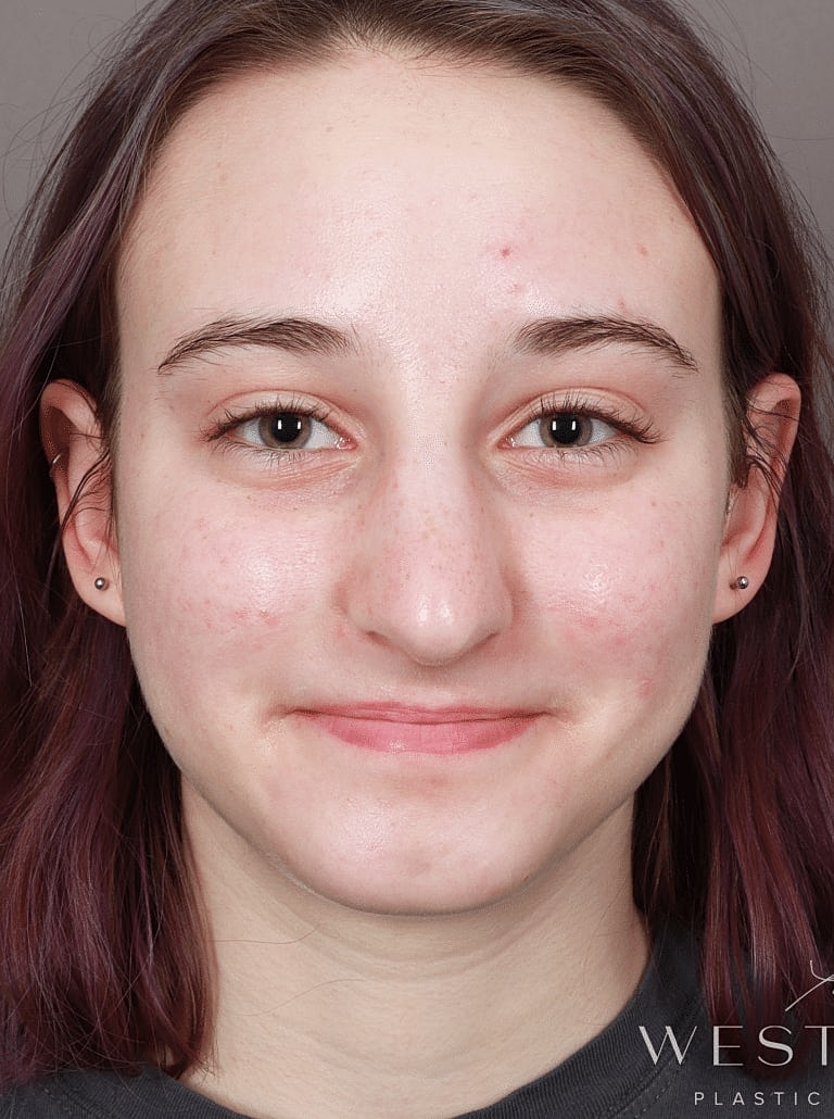 Nose Job Rhinoplasty Before & After