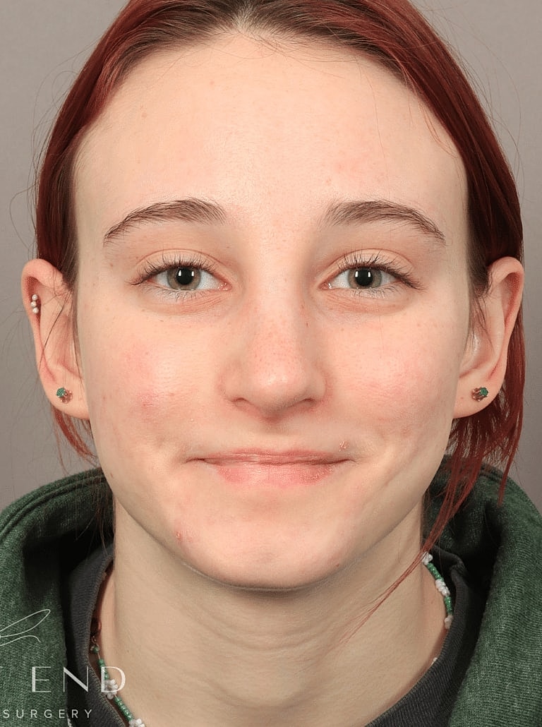 Nose Job Rhinoplasty Before & After