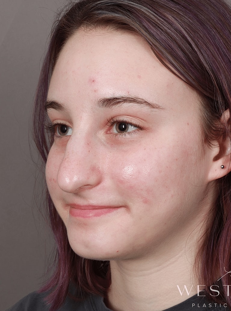 Nose Job Rhinoplasty Before & After