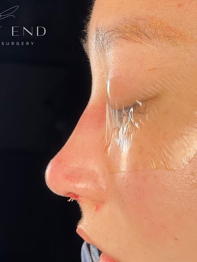 Nose Job Rhinoplasty Before & After