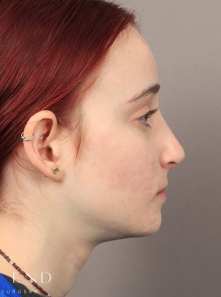 Nose Job Rhinoplasty Before & After