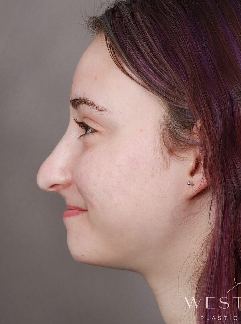 Nose Job Rhinoplasty Before & After