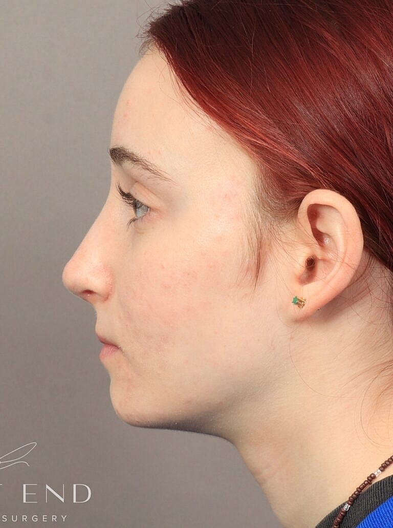 Nose Job Rhinoplasty Before & After