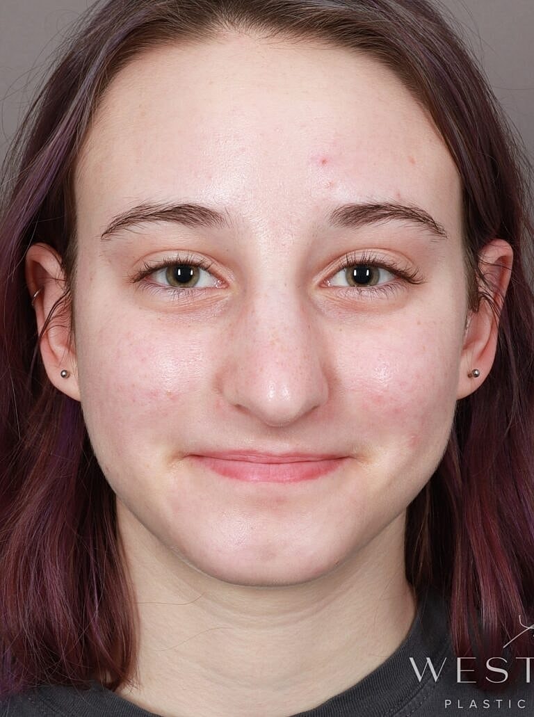 Nose Job Rhinoplasty Before & After