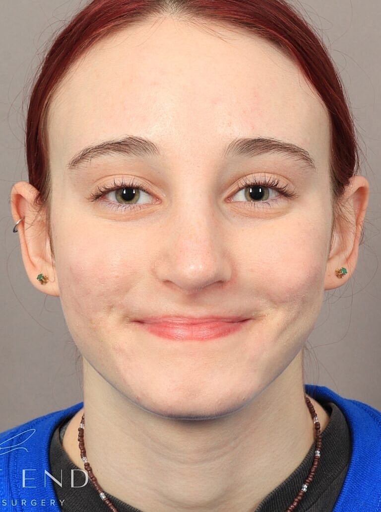 Nose Job Rhinoplasty Before & After