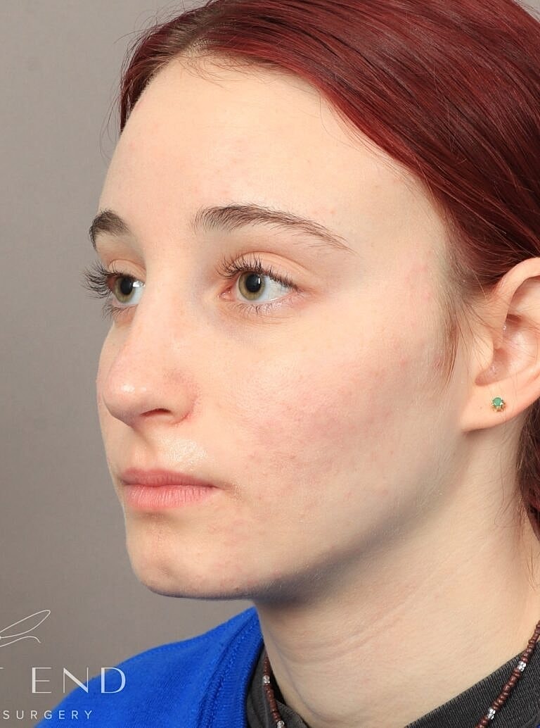 Nose Job Rhinoplasty Before & After