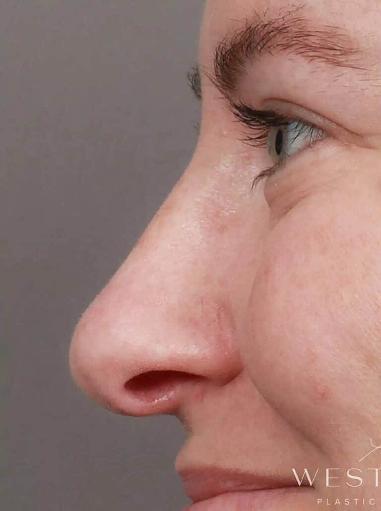 Nose Job Rhinoplasty Before & After