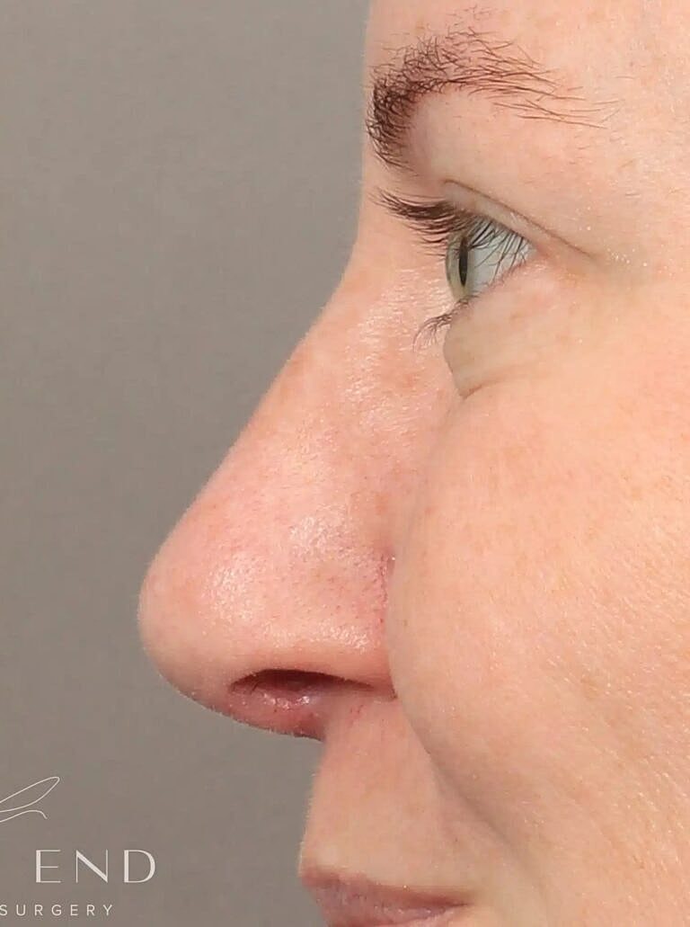 Nose Job Rhinoplasty Before & After