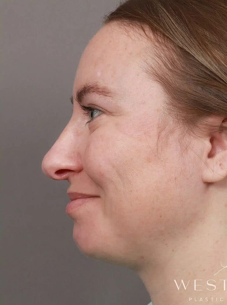 Nose Job Rhinoplasty Before & After