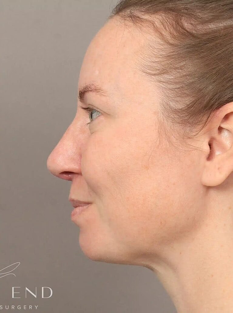 Nose Job Rhinoplasty Before & After