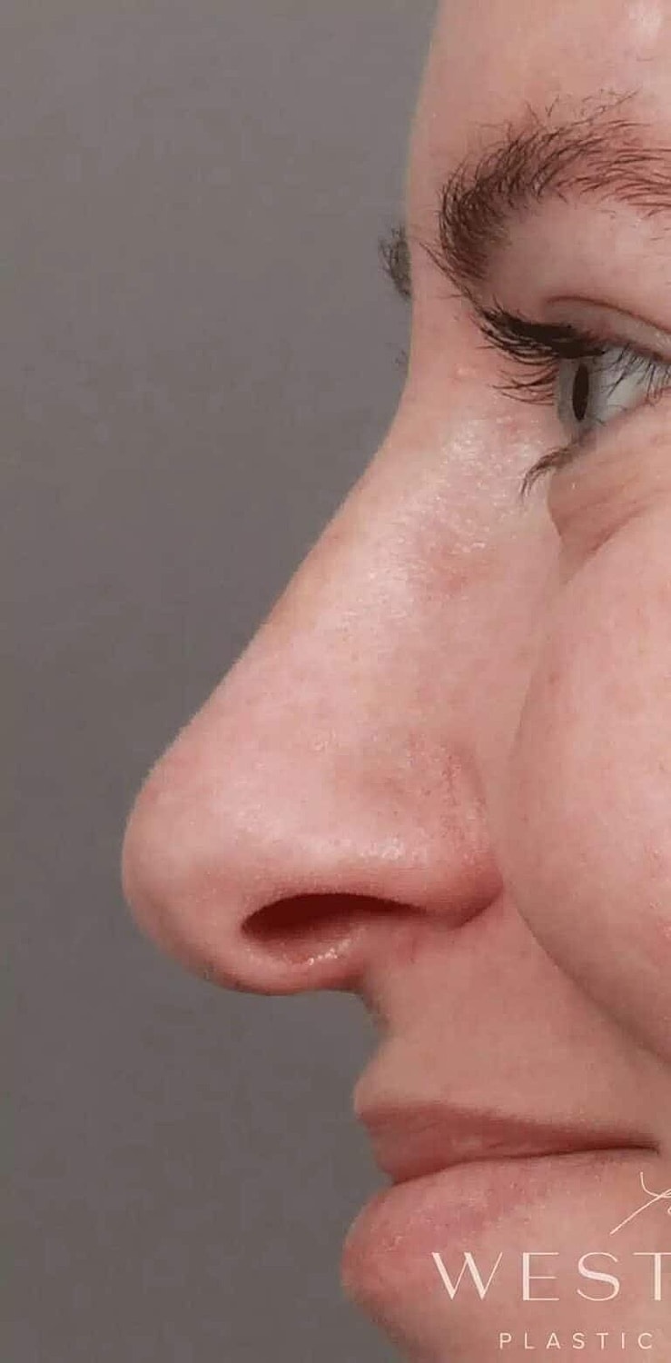 Nose Job Rhinoplasty Before & After