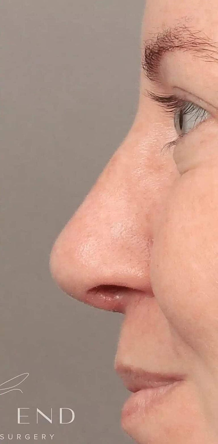 Nose Job Rhinoplasty Before & After