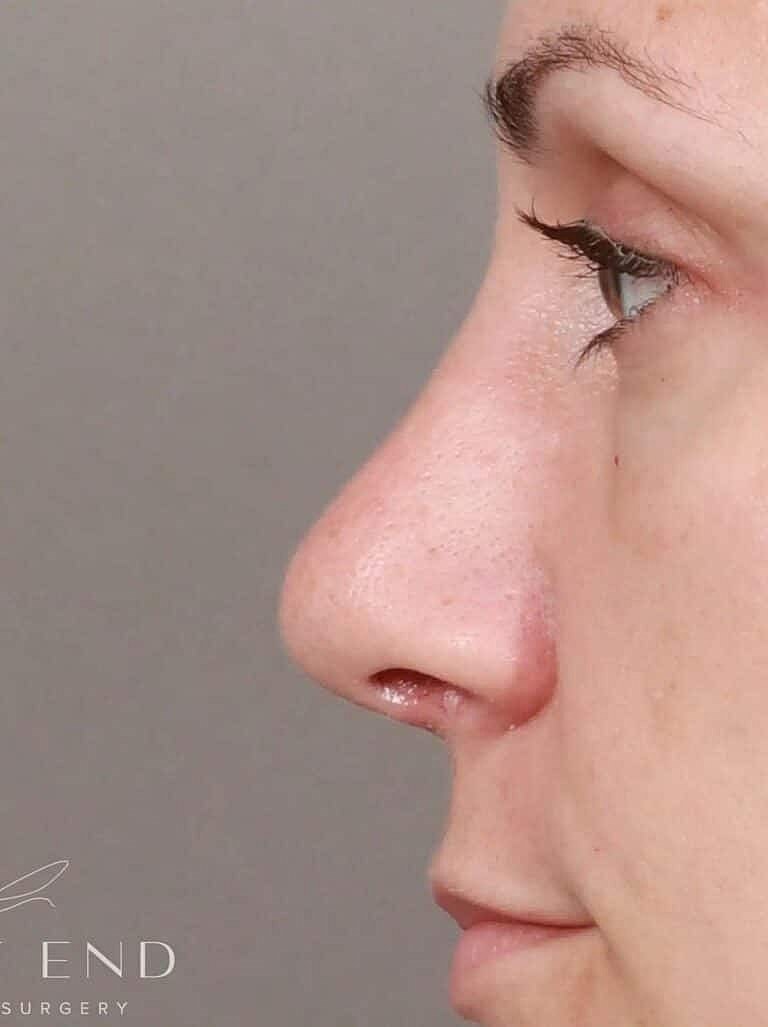 Nose Job Rhinoplasty Before & After