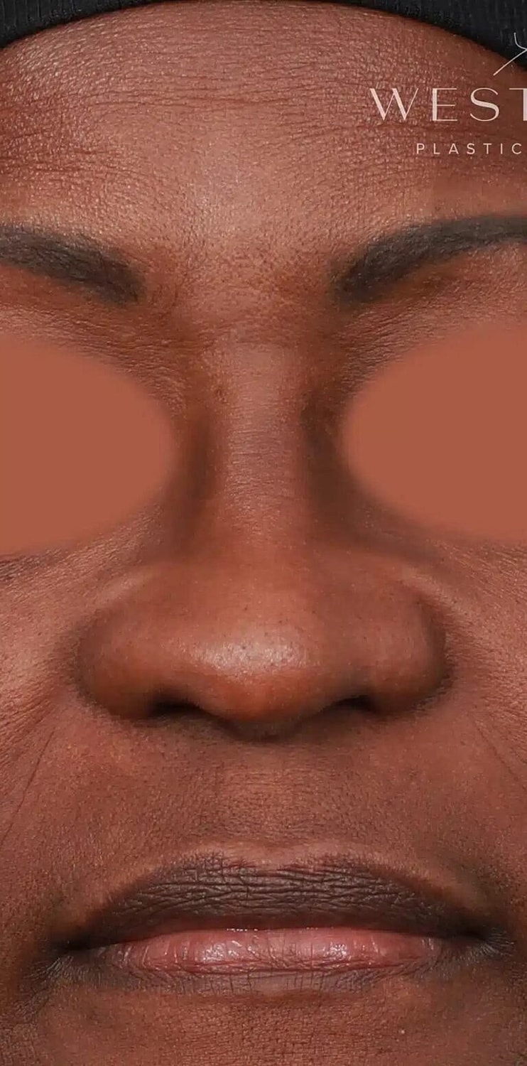 Nose Job Rhinoplasty Before & After