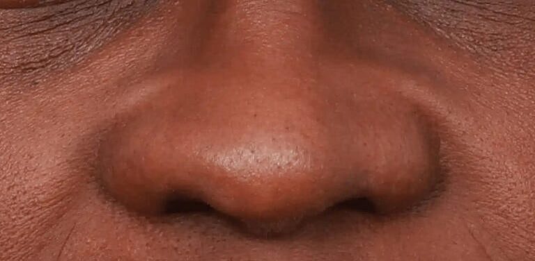 Nose Job Rhinoplasty Before & After