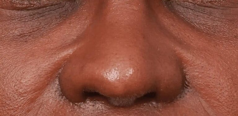 Nose Job Rhinoplasty Before & After