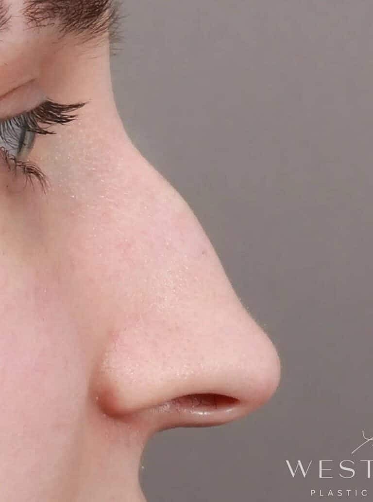 Nose Job Rhinoplasty Before & After