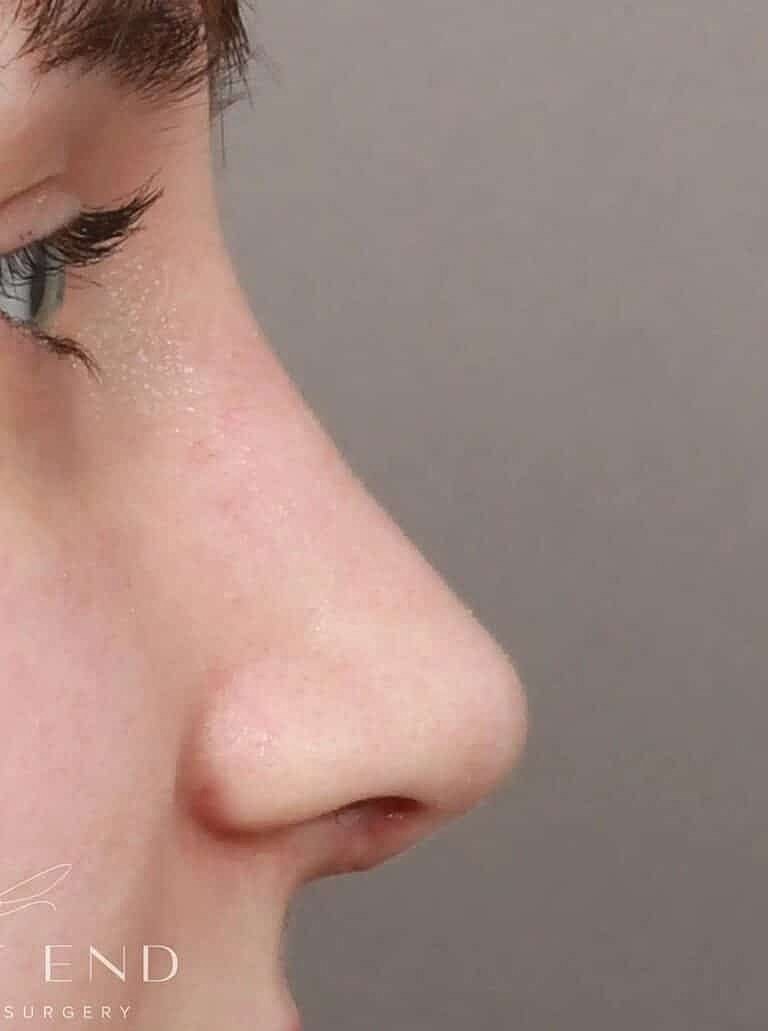 Nose Job Rhinoplasty Before & After