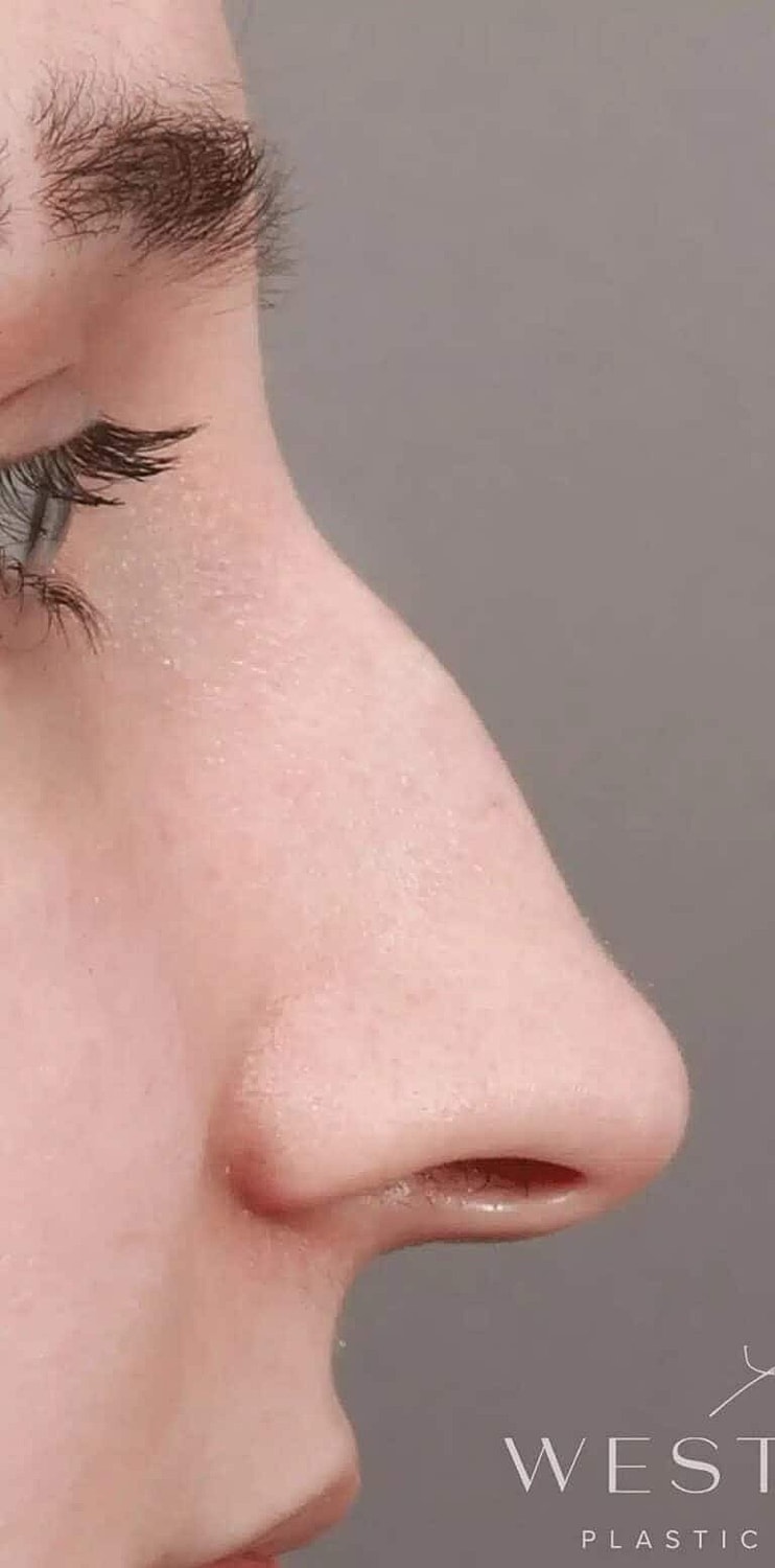 Nose Job Rhinoplasty Before & After