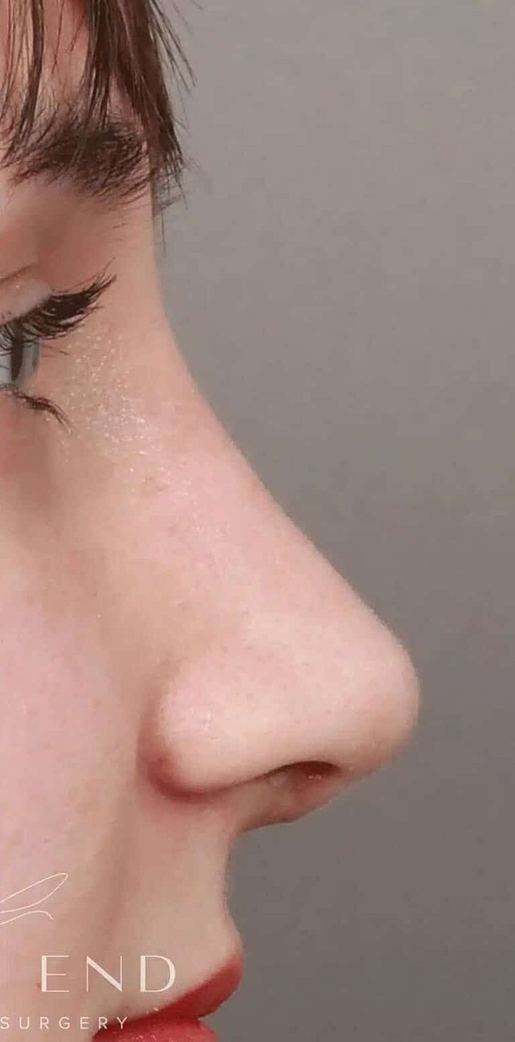 Nose Job Rhinoplasty Before & After