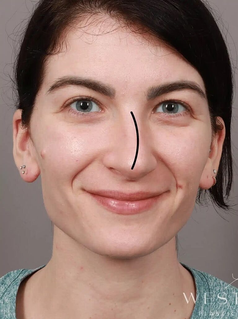 Nose Job Rhinoplasty Before & After