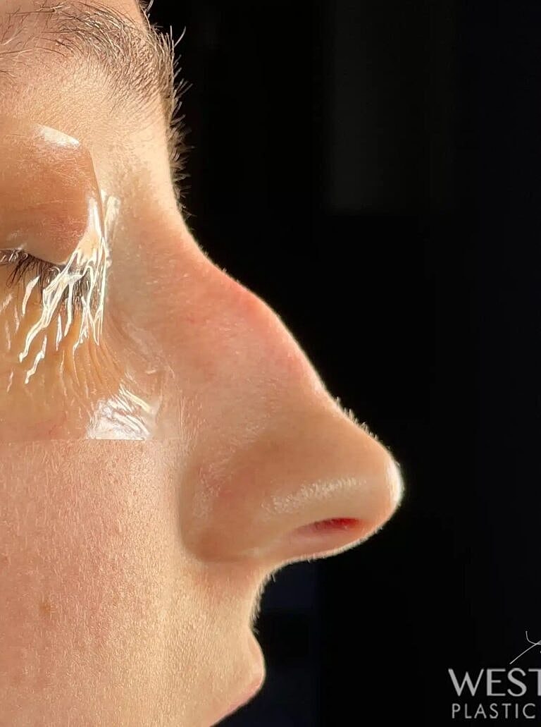 Nose Job Rhinoplasty Before & After