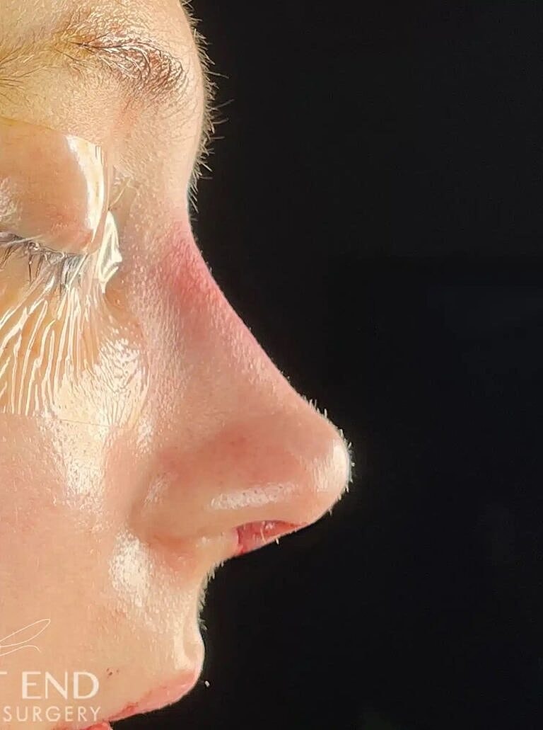 Nose Job Rhinoplasty Before & After