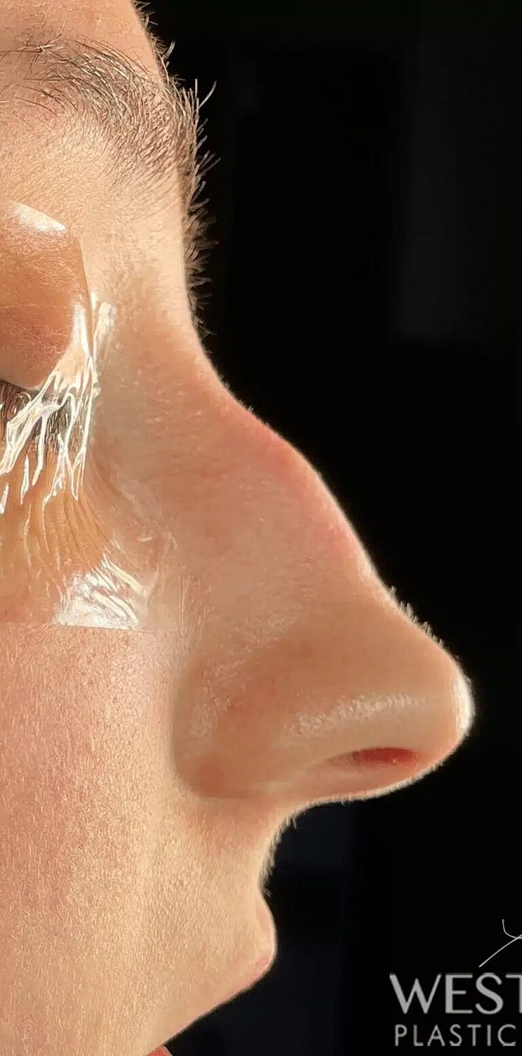 Nose Job Rhinoplasty Before & After