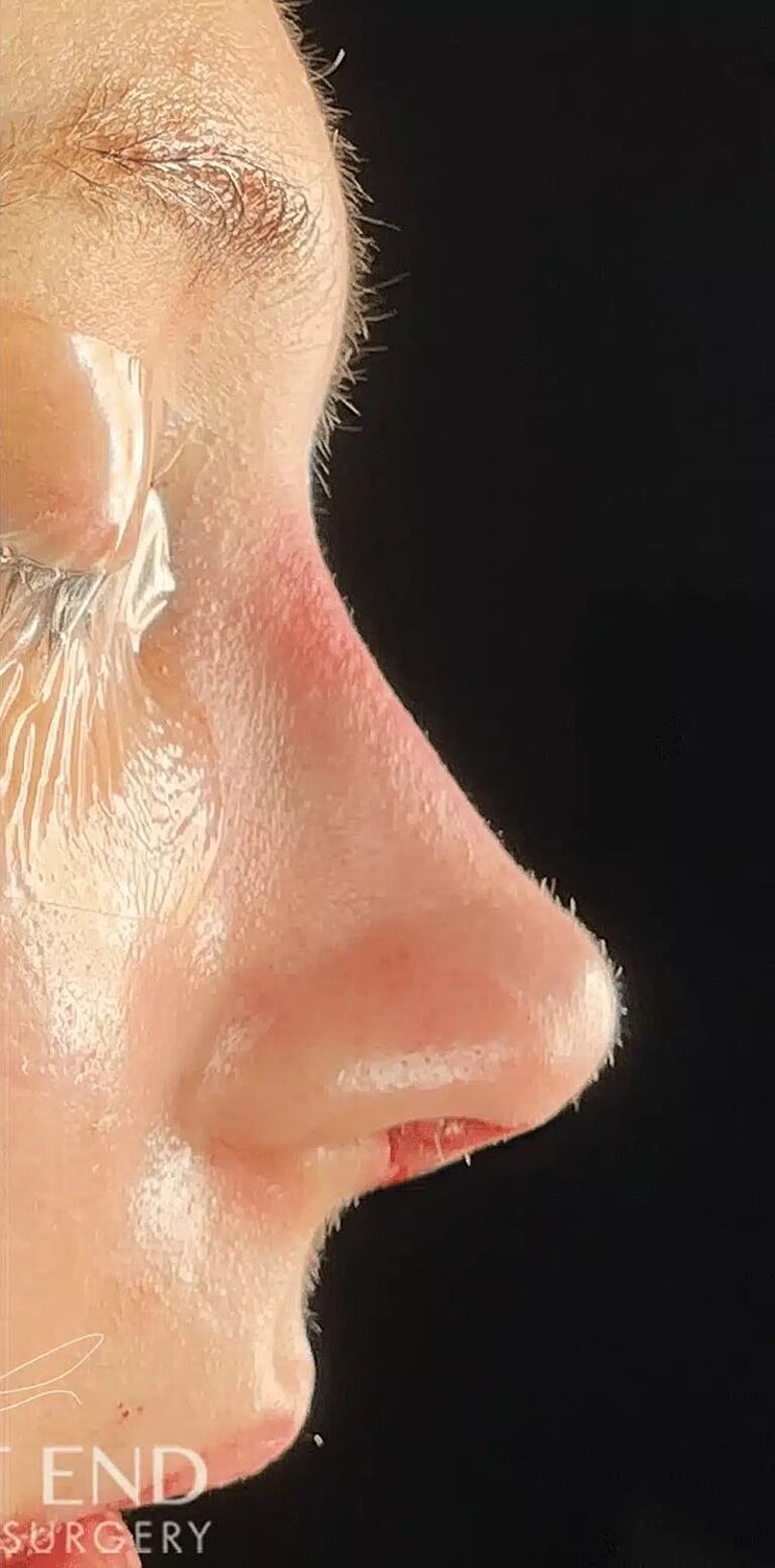 Nose Job Rhinoplasty Before & After