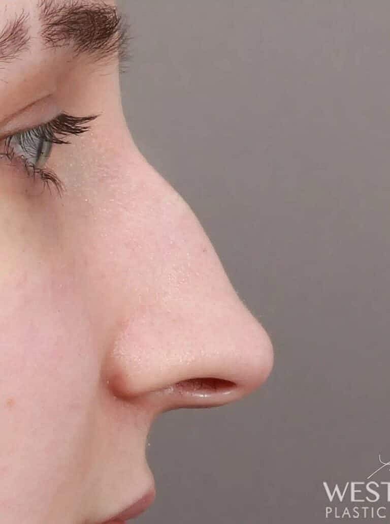 Nose Job Rhinoplasty Before & After
